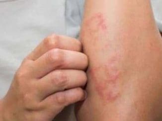 Lepramorelos focus La Silla Rota