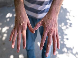 Viruela mono mexico gettyimages