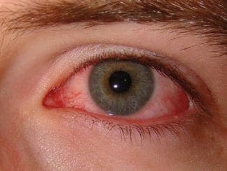 Conjuntivitis tratamiento madrid